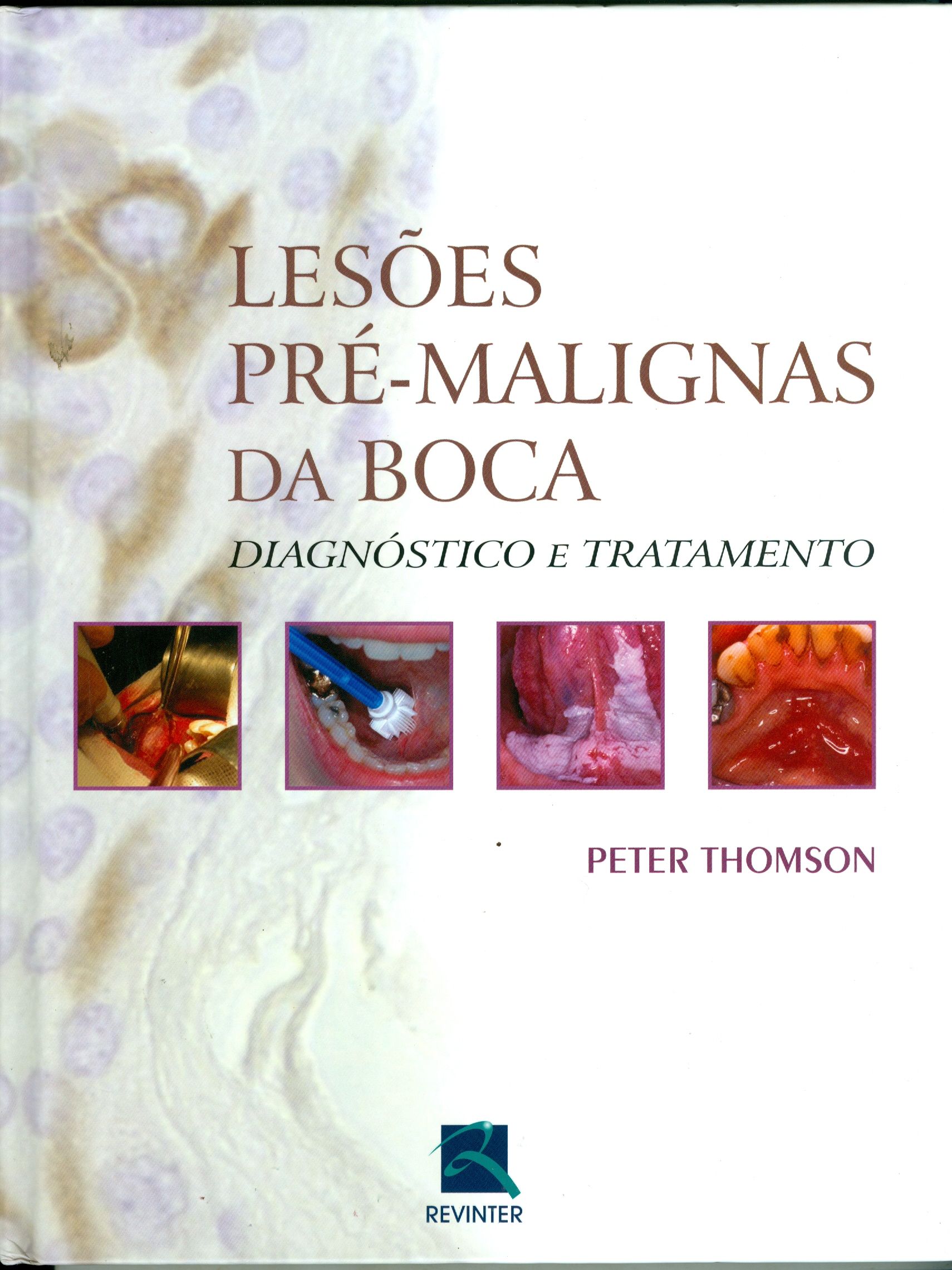 LESÕES PRÉ-MALIGNAS DA BOCA