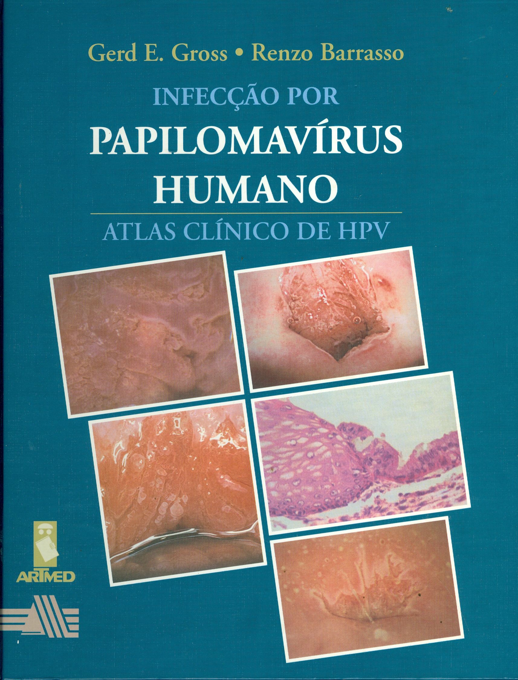 INFECÇÃO POR PAPILOMAVÍRUS HUMANO